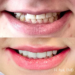 Before and after smile at Singing River Dentistry