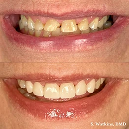 Before and after smile at Singing River Dentistry