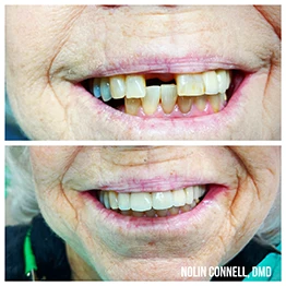 Before and after smile at Singing River Dentistry