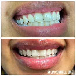 Before and after smile at Singing River Dentistry