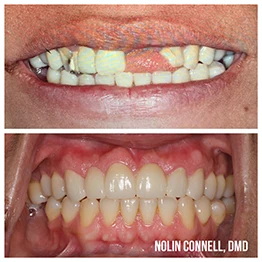 Before and after smile at Singing River Dentistry