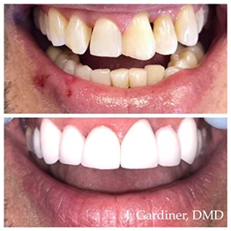 Before and after smile at Singing River Dentistry