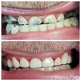 Before and after smile at Singing River Dentistry