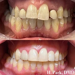 Before and after smile at Singing River Dentistry