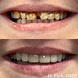 Before and after smile at Singing River Dentistry