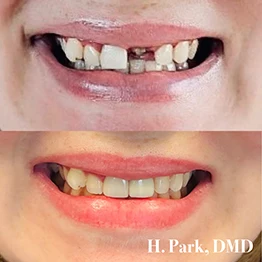 Before and after smile at Singing River Dentistry