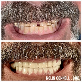 Before and after smile at Singing River Dentistry