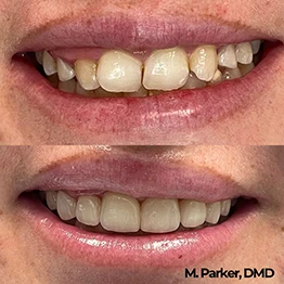 Before and after smile at Singing River Dentistry