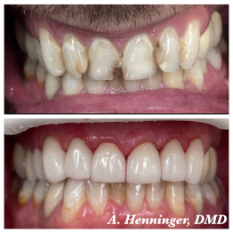 Before and after smile at Singing River Dentistry