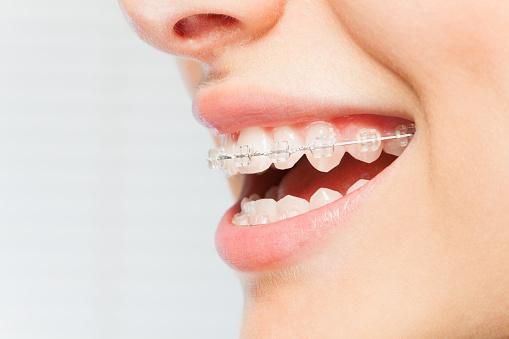 dentist Florence AL - Metal Braces Vs. Ceramic Braces