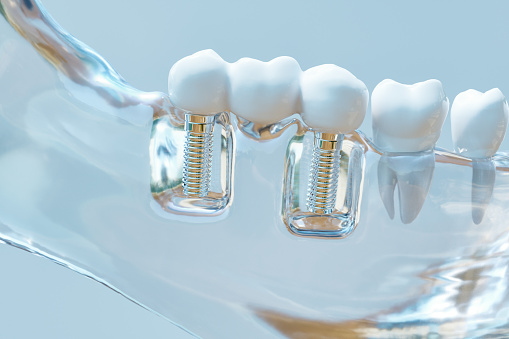 An example of a dental implant at Singing River Dentistry.