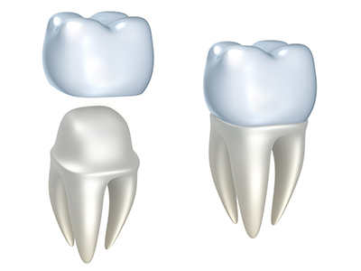 CEREC Same-Day Crowns: Taking the Hassle Out of Tooth Repair