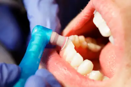 close up of patient's mouth and polisher during a dental cleaning