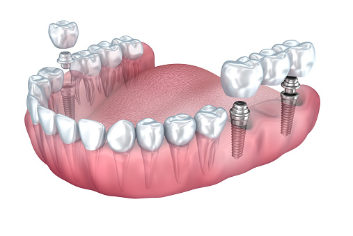 digital rendering of a mouth showing a single dental implant on the lower right jaw and an implant supported dental bridge on the lower left jaw at Singing River Dentistry in Russellville, AL