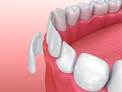 Illustration of teeth getting dental veneers applied
