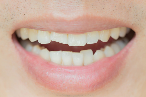 Cracked tooth