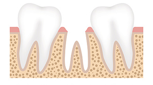 An example of a jaw with tooth looss at Singing River Dentistry in Tuscumbia, AL