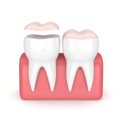 Illustration of two white teeth with onlays