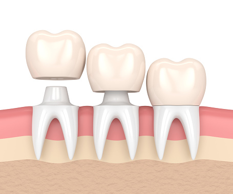 3D rendering showing the placement of a dental crown on a tooth abutmentSinging River Dentistry in Russellville, AL