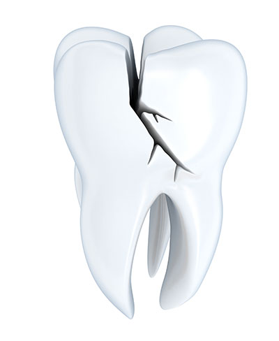 Steps We Can Take to Fix Your Cracked Tooth