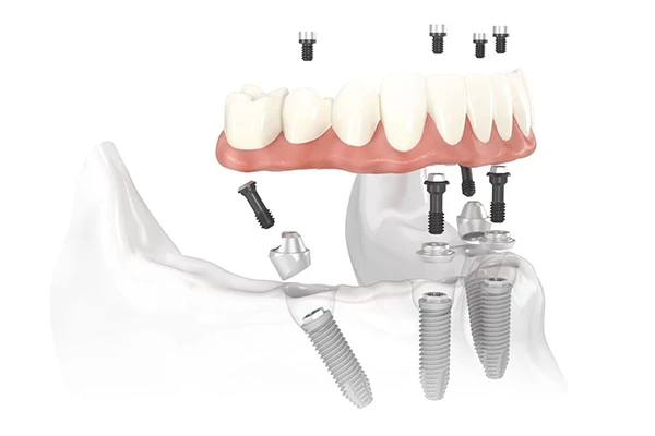 Diagram of All-on-4 Treatment Concept implant bridge placed in the jaw at Singing River Dentistry in Muscle Shoals, AL 