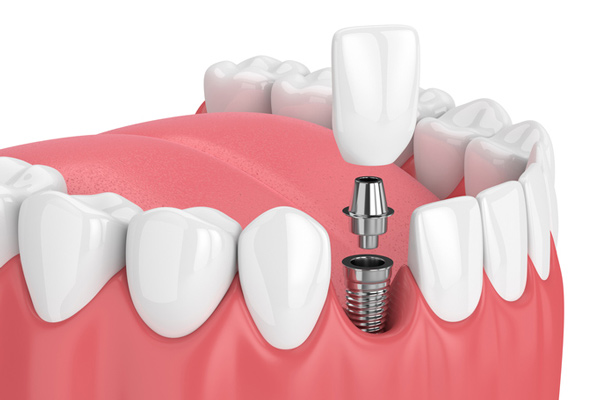  Diagram of a single dental implant at Singing River Dentistry 