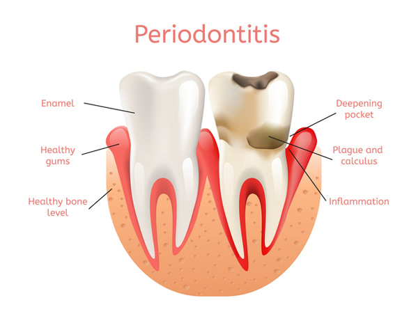 Diagram of a healthy tooth versus a tooth with periodontitisSinging River Dentistry in Muscle Shoals, AL 35661