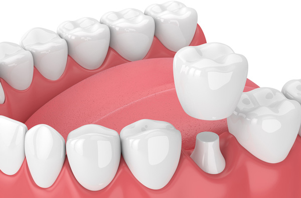 Rendering of jaw with dental crown at Singing River Dentistry.