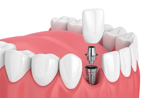 Rendering of jaw with dental implant at Singing River Dentistry in Muscle Shoals AL 35661 