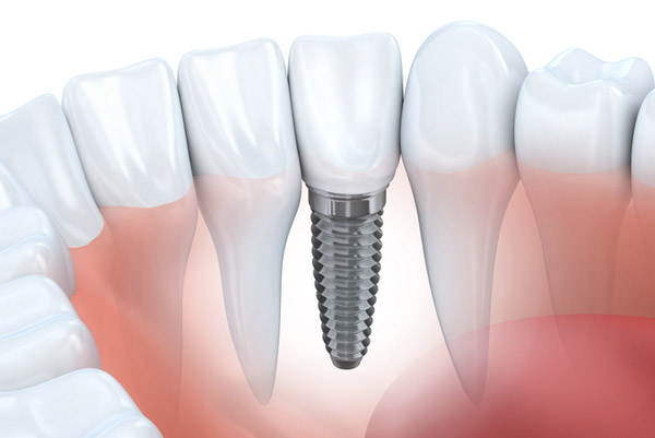 All-on-4 Full Mouth Dental Implants, Florence