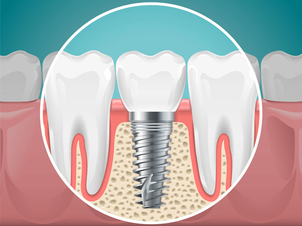 Diagram of a tooth replaced with a dental implant by Singing River Dentistry in Muscle Shoals AL 35661 