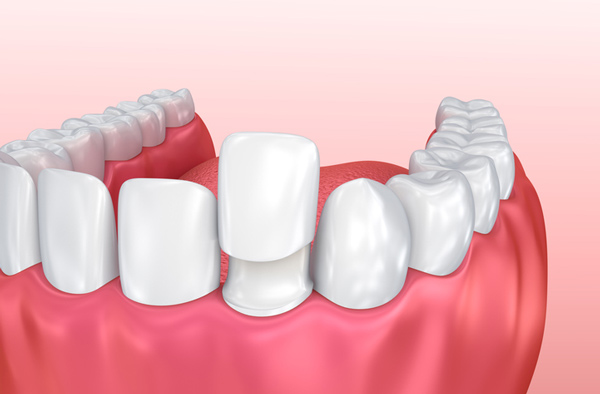 Rendering of jaw with porcelain veneer on tooth.