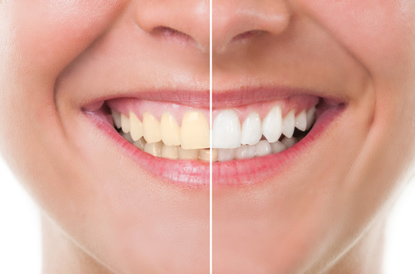 Before and after photo of teeth whitening treatment at Singing River Dentistry in Muscle Shoals, AL 