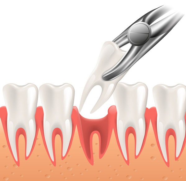 Illustration of a tooth being extracted at Singing River Dentistry 