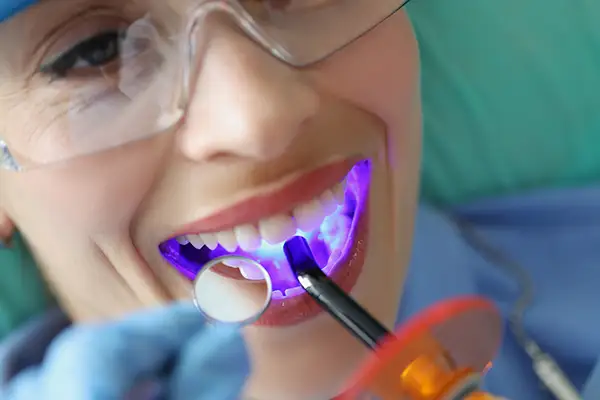 Close-up of a dentist applying a dental sealant to a patient's teeth using a curing light, with the patient wearing protective glasses.