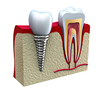 Diagram of dental implant with post from Singing River Dentistry in Tuscumbia, AL